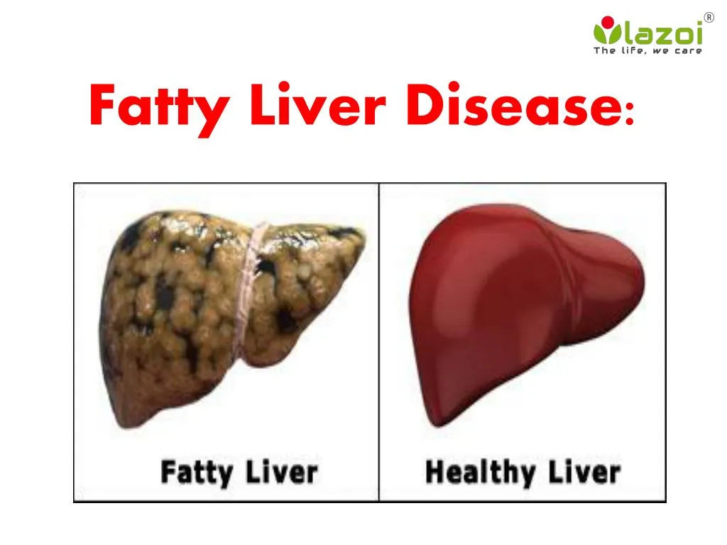 PPT - Fatty Liver Disease: Information on symptoms, causes and