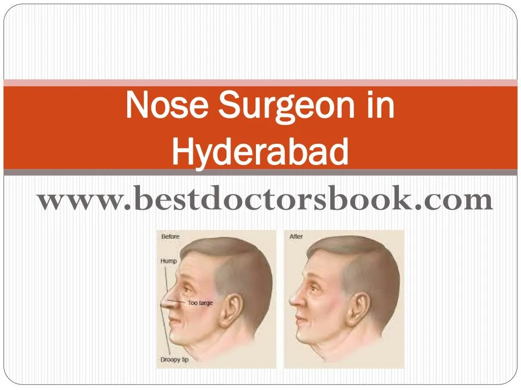 nose surgeon in hyderabad n.