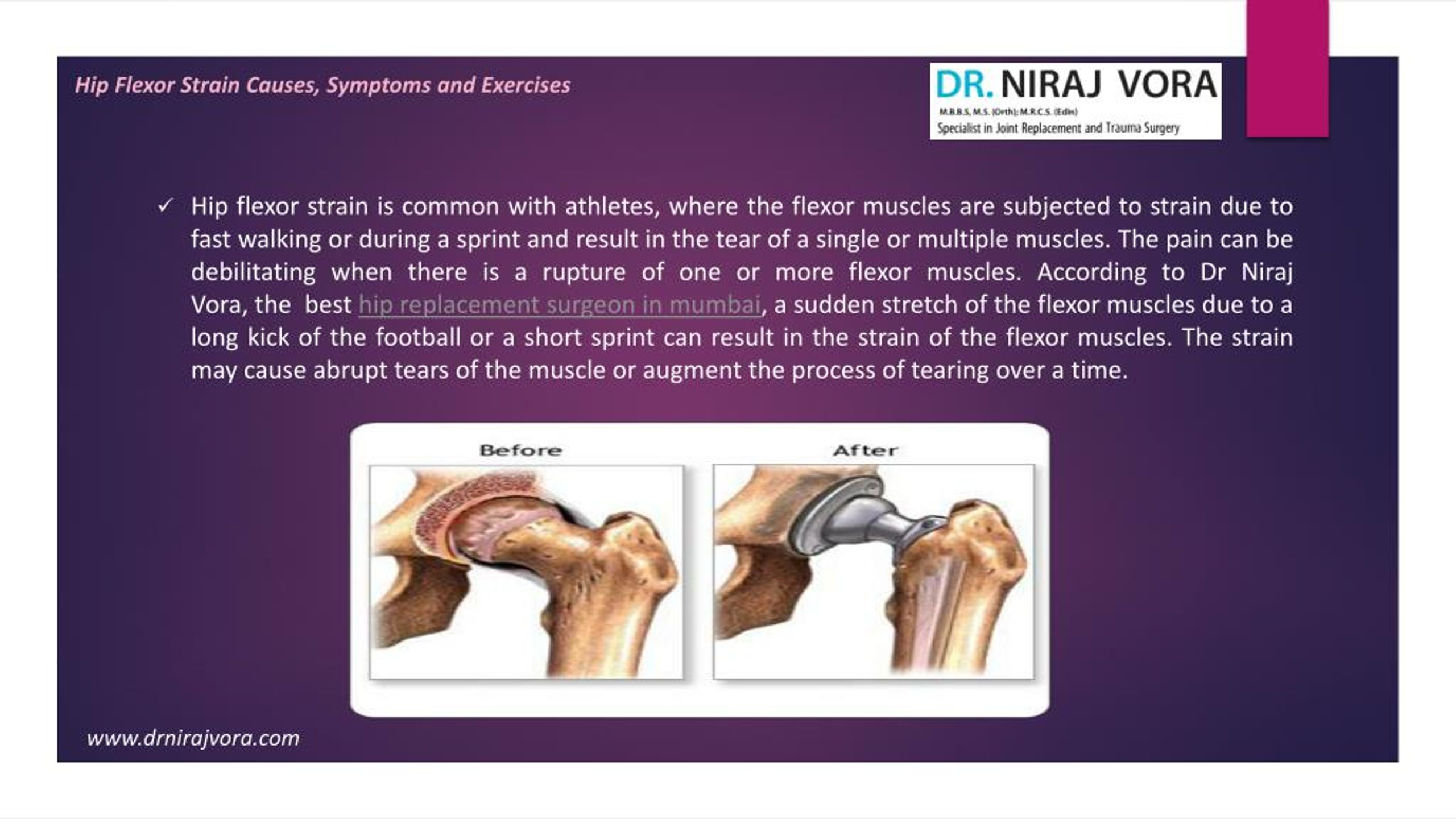 PPT - Symptoms for Hip Flexor Strain Causes By Dr. Niraj ...