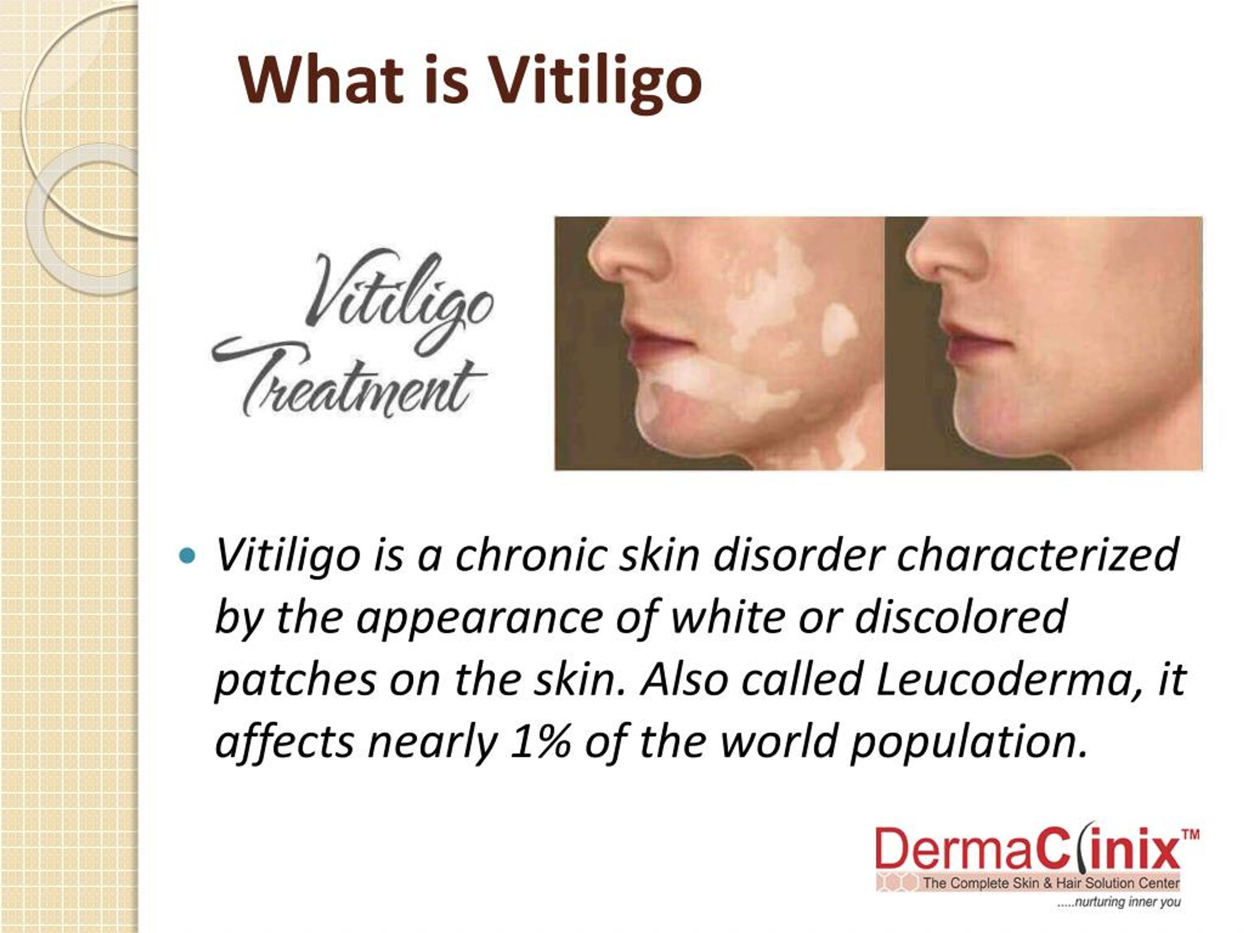 Ppt Best Vitiligo Treatment In South Delhi Powerpoint Presentation