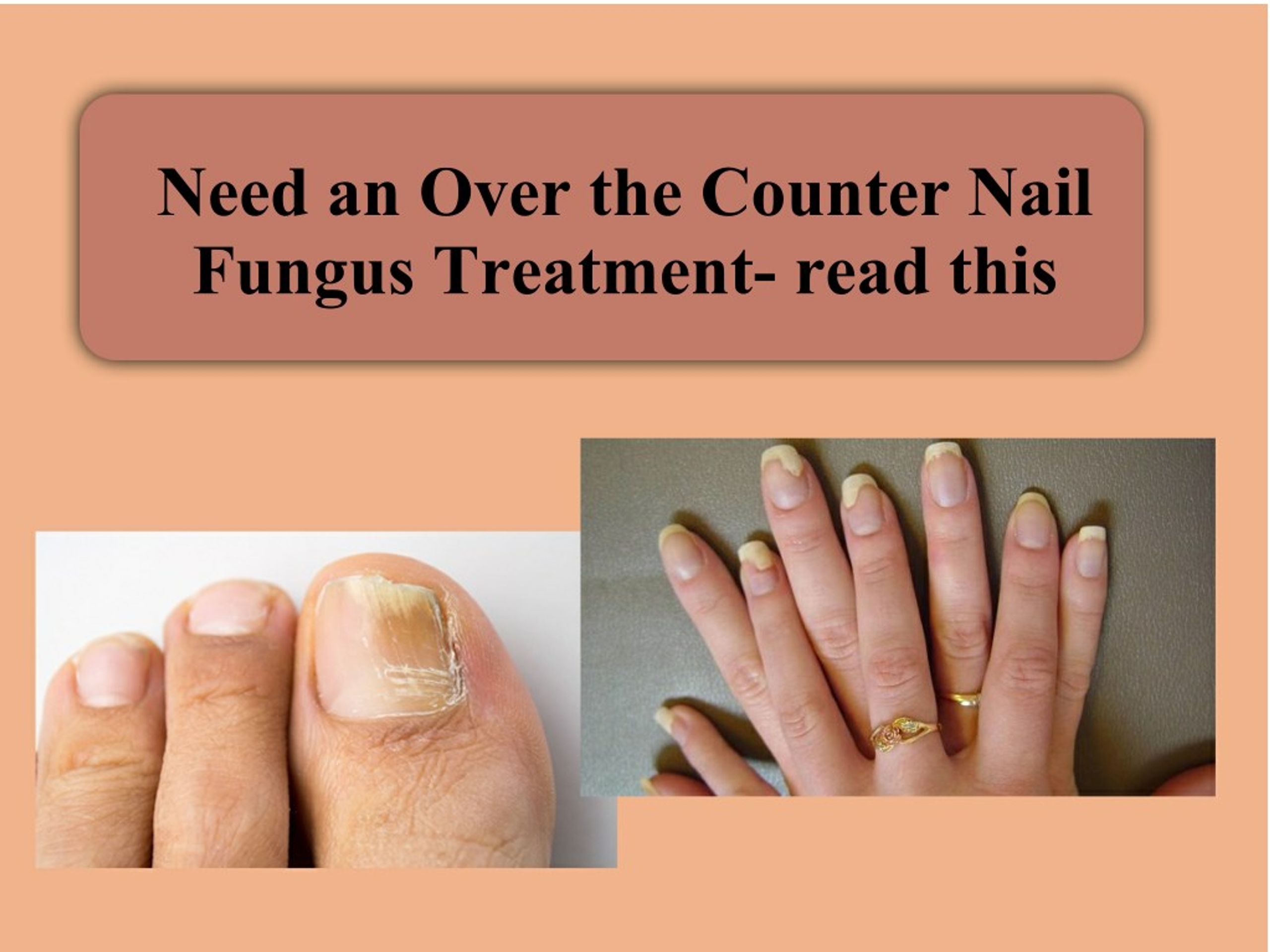 Tazarotene as alternative topical treatment for onychomycosis | DDDT