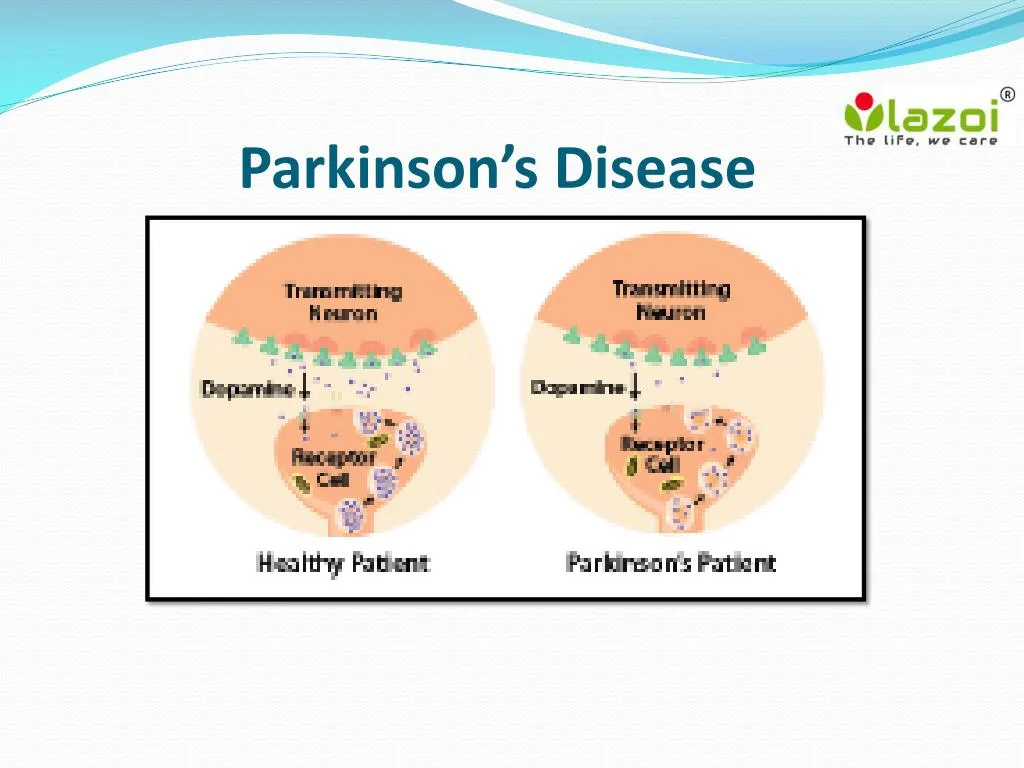 Ppt Parkinsons Disease Overview Symptoms Causes Treatment And The