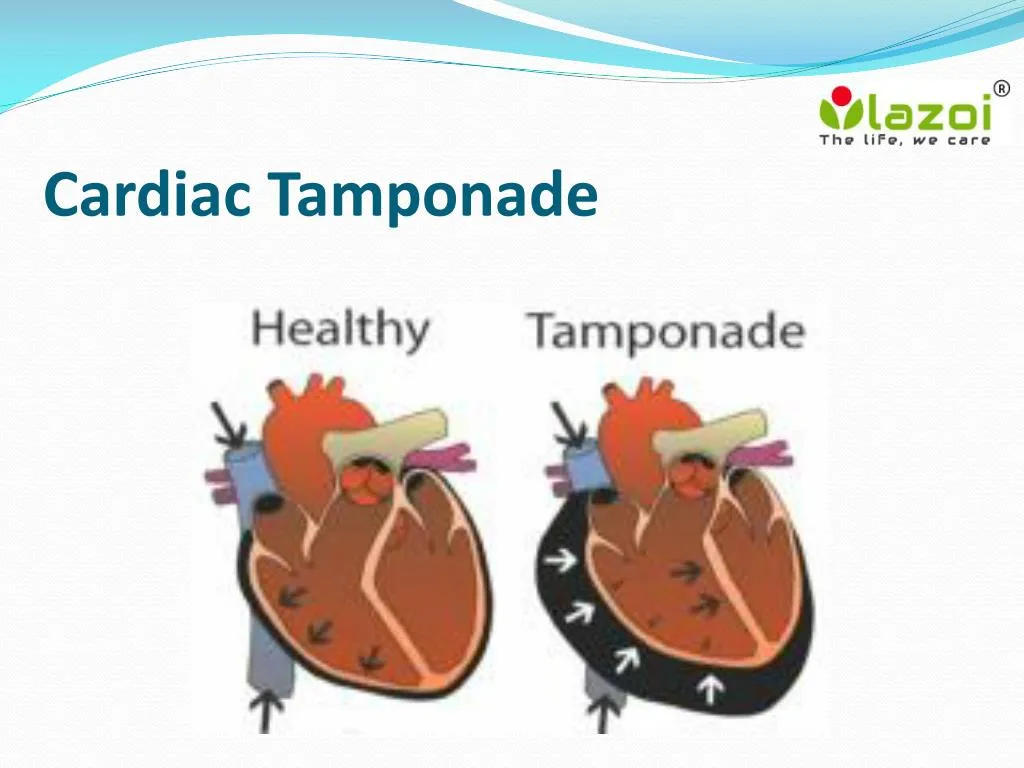 PPT Cardiac Tamponade Overview, Symptoms, Signs, Causes, Risk factor