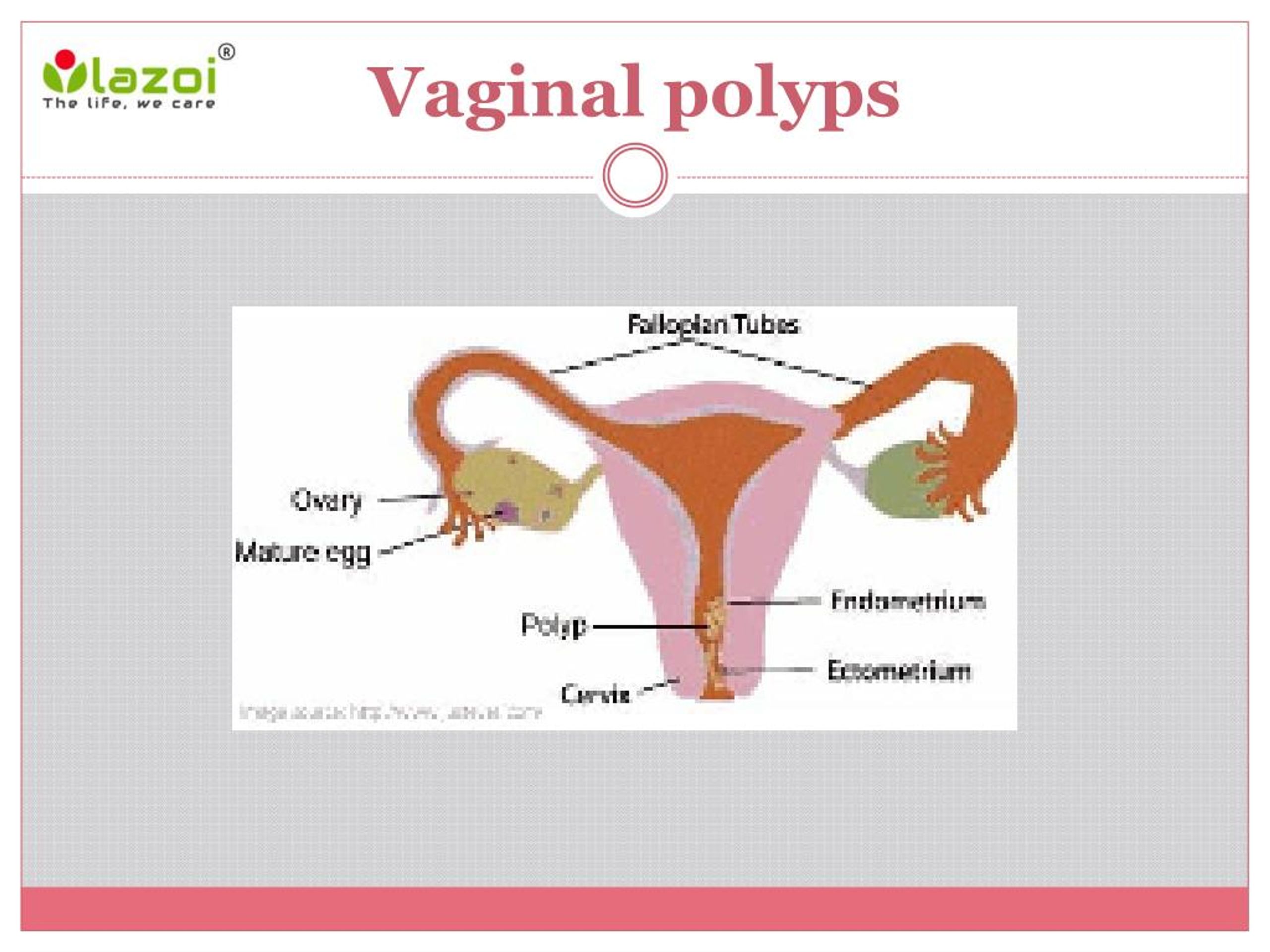 Ppt Vaginal Polyps Causes Symptoms Diagnosis And Treatment Powerpoint Presentation Id 4153