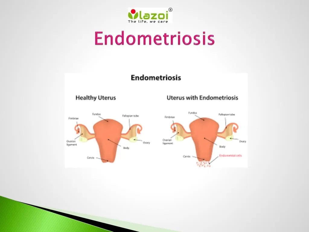 PPT - Endometriosis : Overview, Sign, Symptoms, Causes Diagnosis and ...