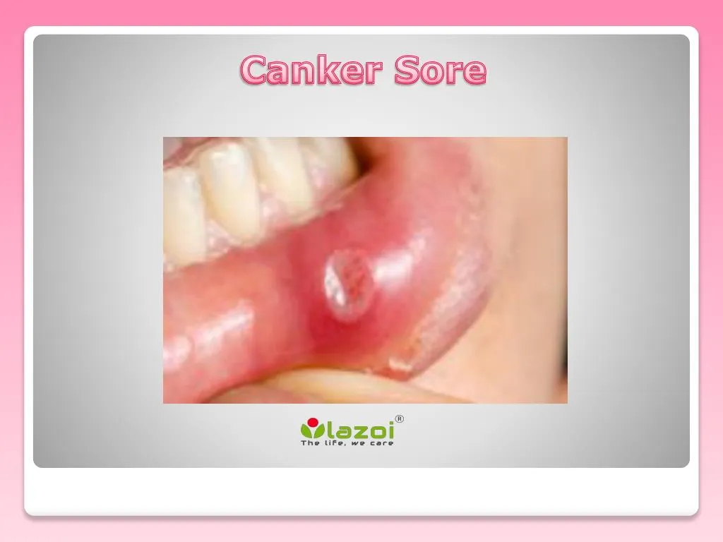 Ppt Canker Sore Causes Symptoms Diagnosis And Treatment Powerpoint Presentation Id 7636052