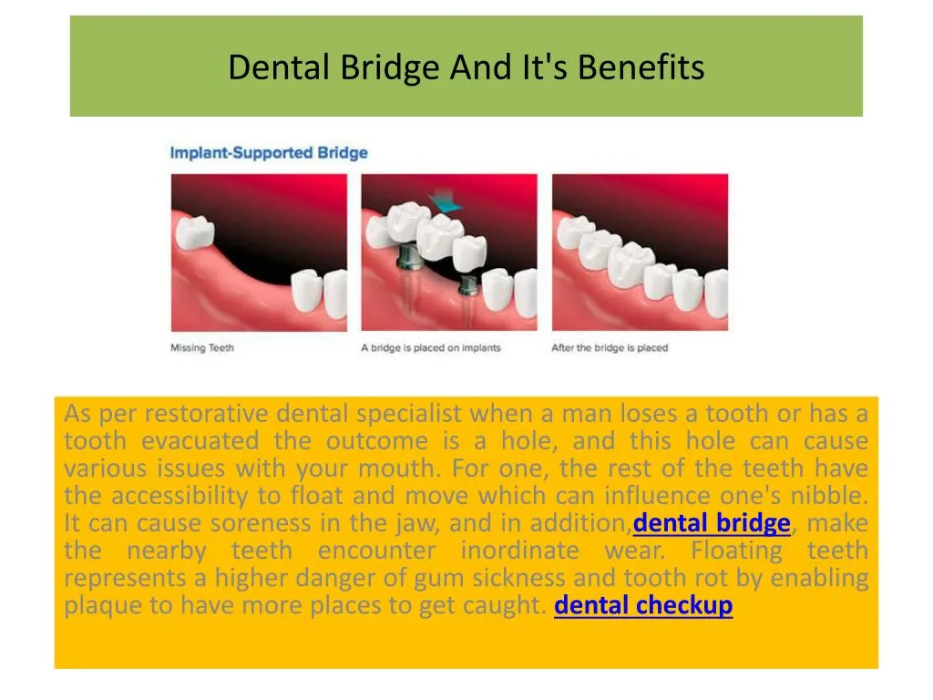 PPT - Dental Bridge And It's Benefits PowerPoint Presentation, Free ...