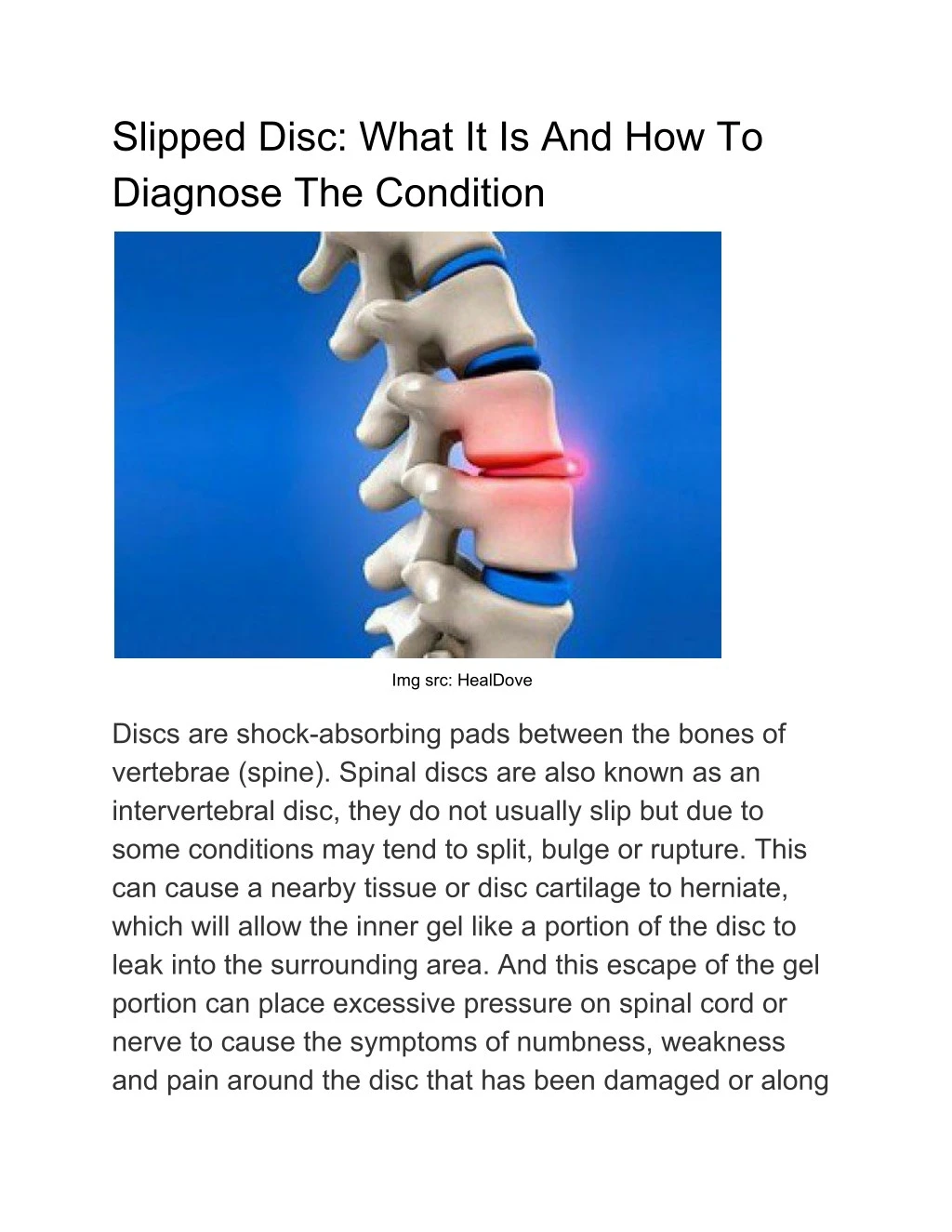 PPT Slipped Disc What It Is And How To Diagnose The Condition