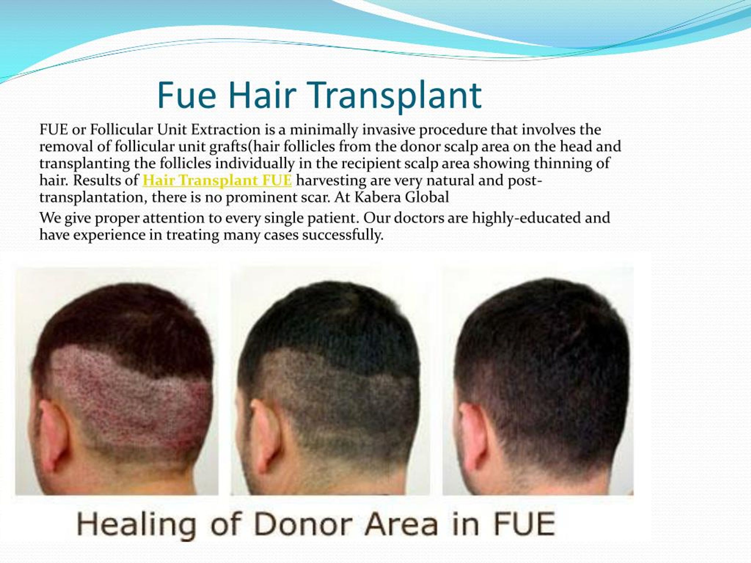 PPT - WELCOME TO KABERA GLOBAL Hair Transplant in Delhi PowerPoint  Presentation - ID:7655944