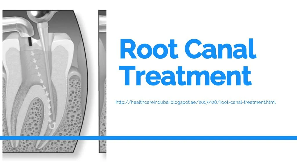 root canal treatment n.