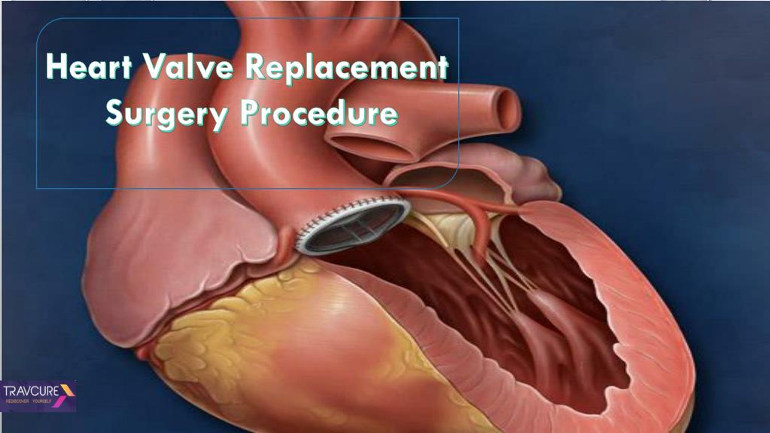 ppt-heart-valve-replacement-surgery-procedure-powerpoint-presentation