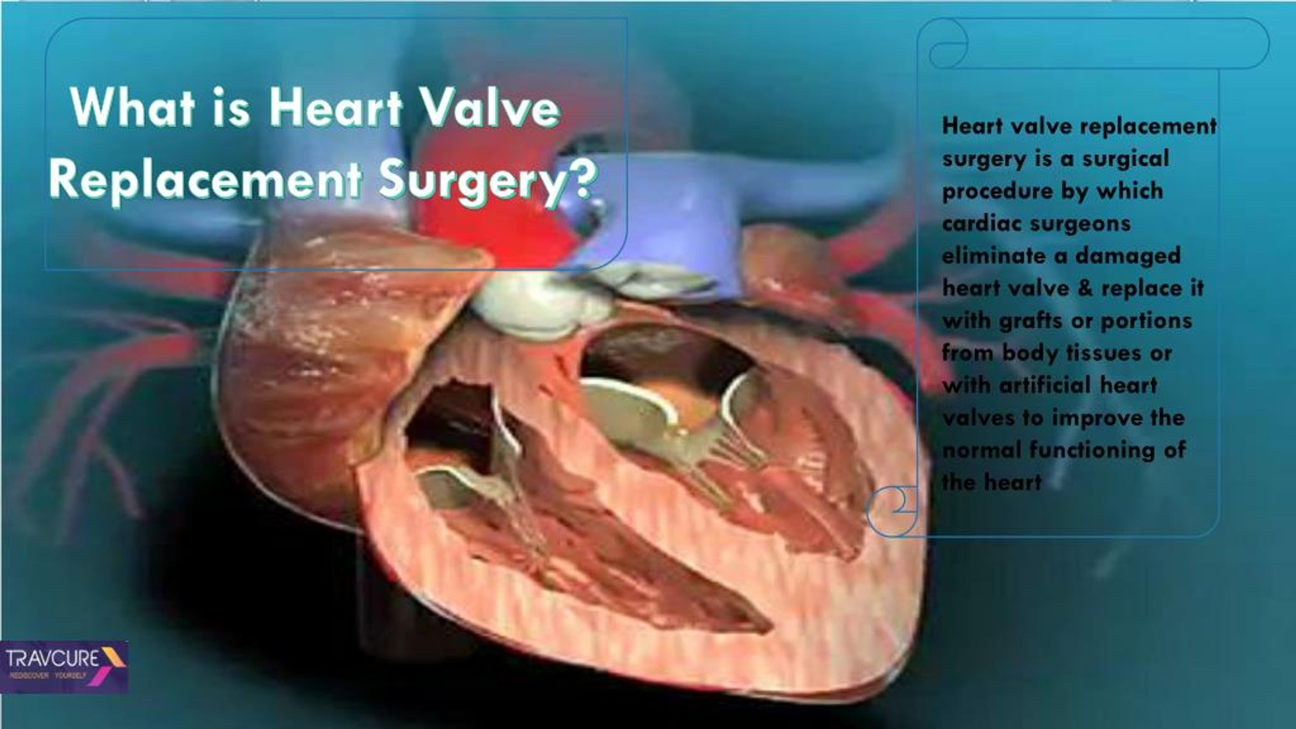 Ppt Heart Valve Replacement Surgery Procedure Powerpoint Presentation