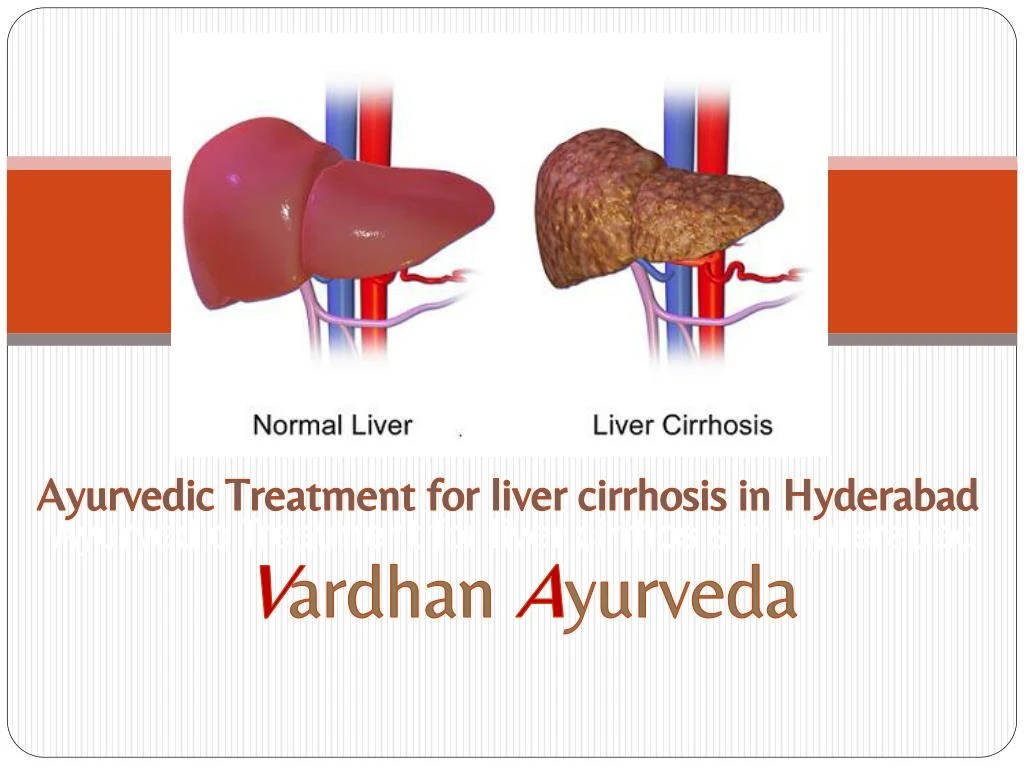 PPT - Ayurvedic Treatment For Liver Cirrhosis In Hyderabad | Vardhan ...