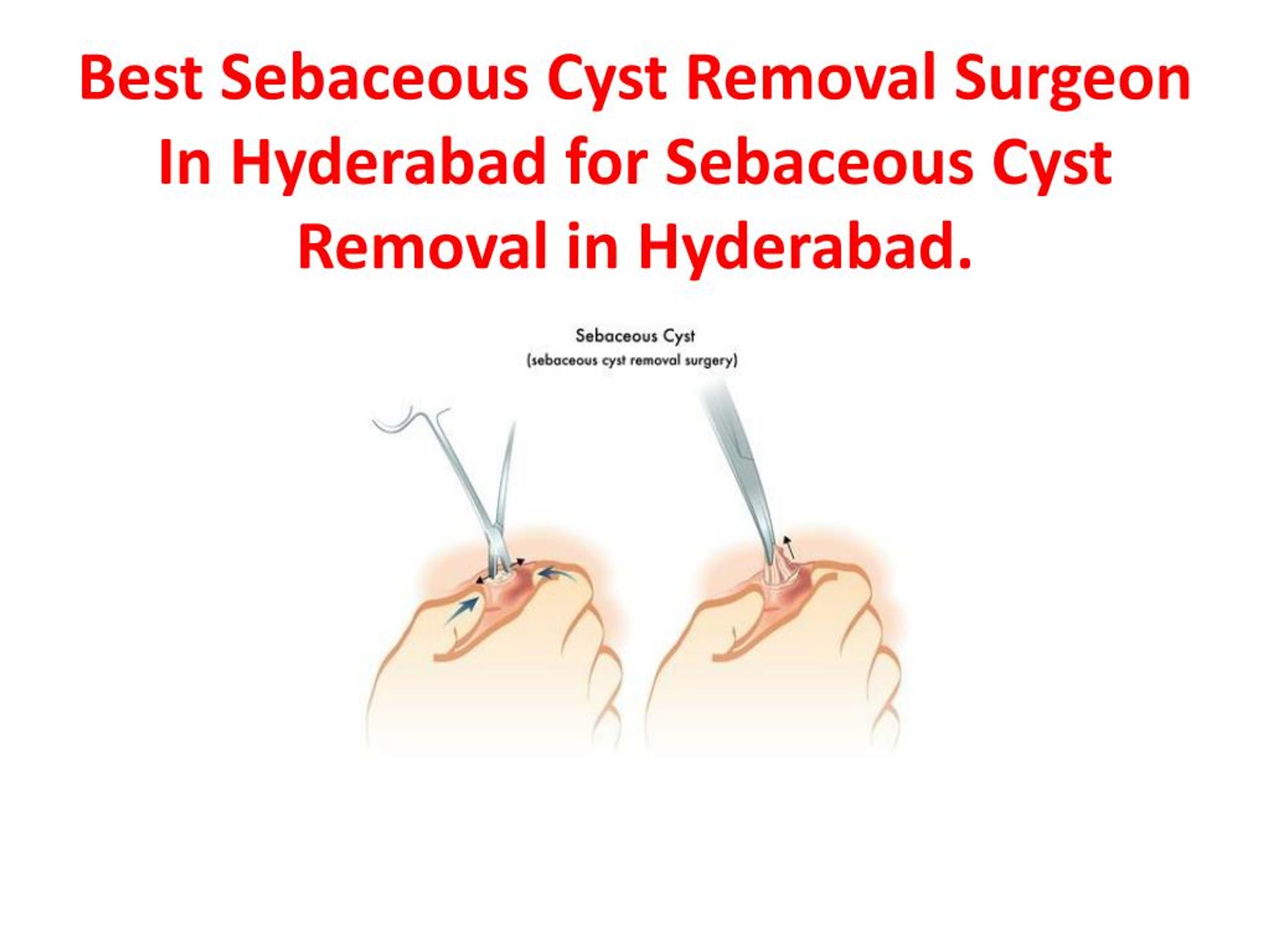 Ppt Sebaceous Cyst Removal In Hyderabad Powerpoint Presentation Free