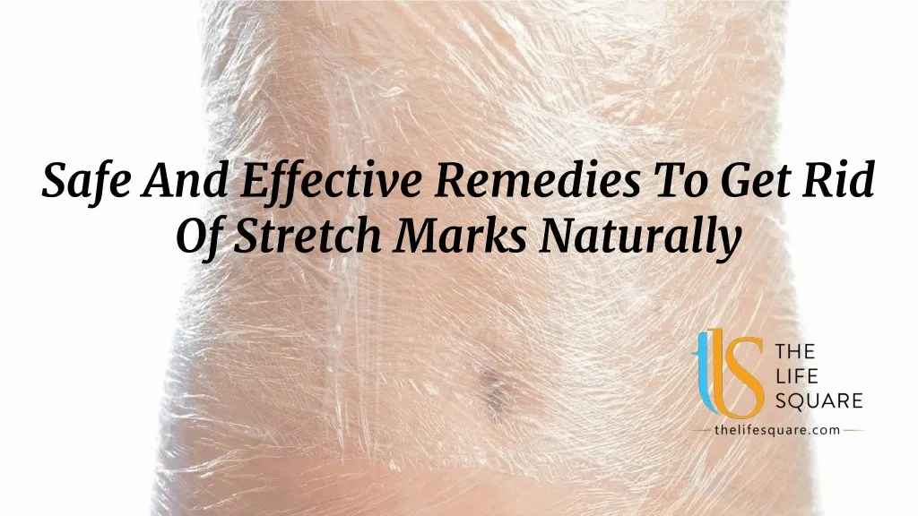 PPT - Safe And Effective Remedies To Get Rid Of Stretch Marks Naturally