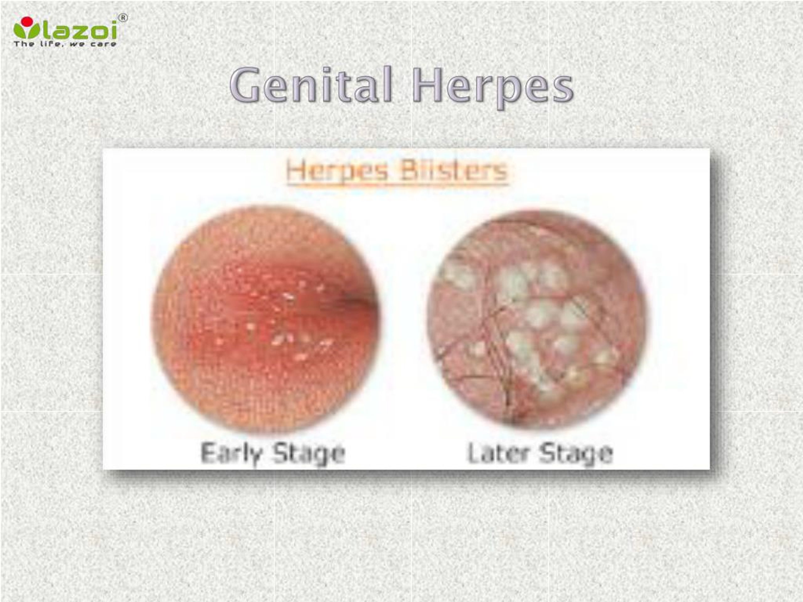 genital herpes.