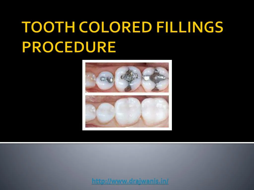 tooth colored fillings procedure n.