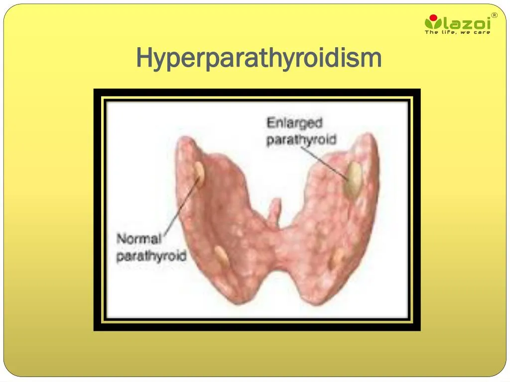 Understanding Hyperparathyroidism Youtube