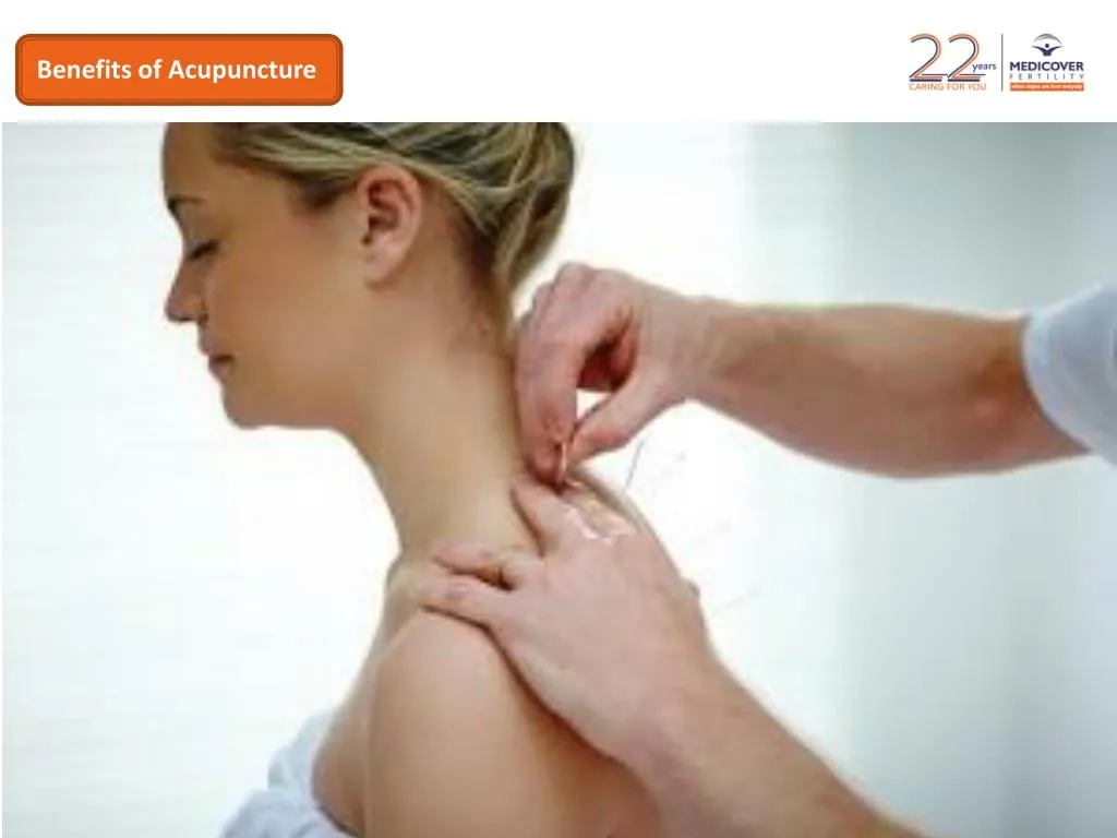 benefits of acupuncture n.