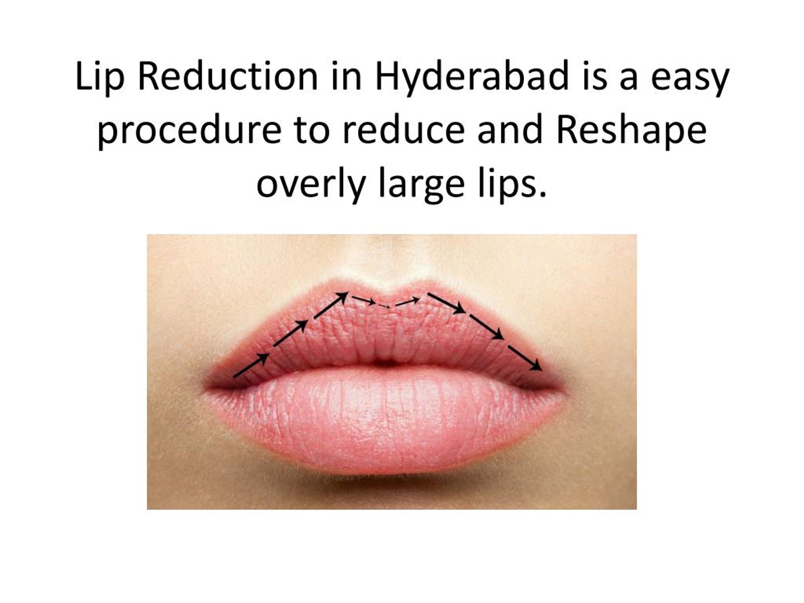 PPT Lip Reduction in Hyderabad Lip Reduction Surgery Cost Hyderabad