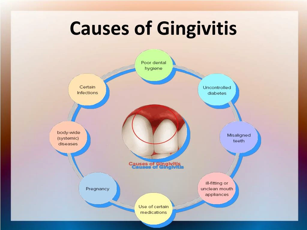 Pathophysiology Of Gingivitis