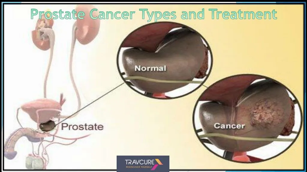 Ppt Prostate Cancer Symptoms Types And Treatment Powerpoint