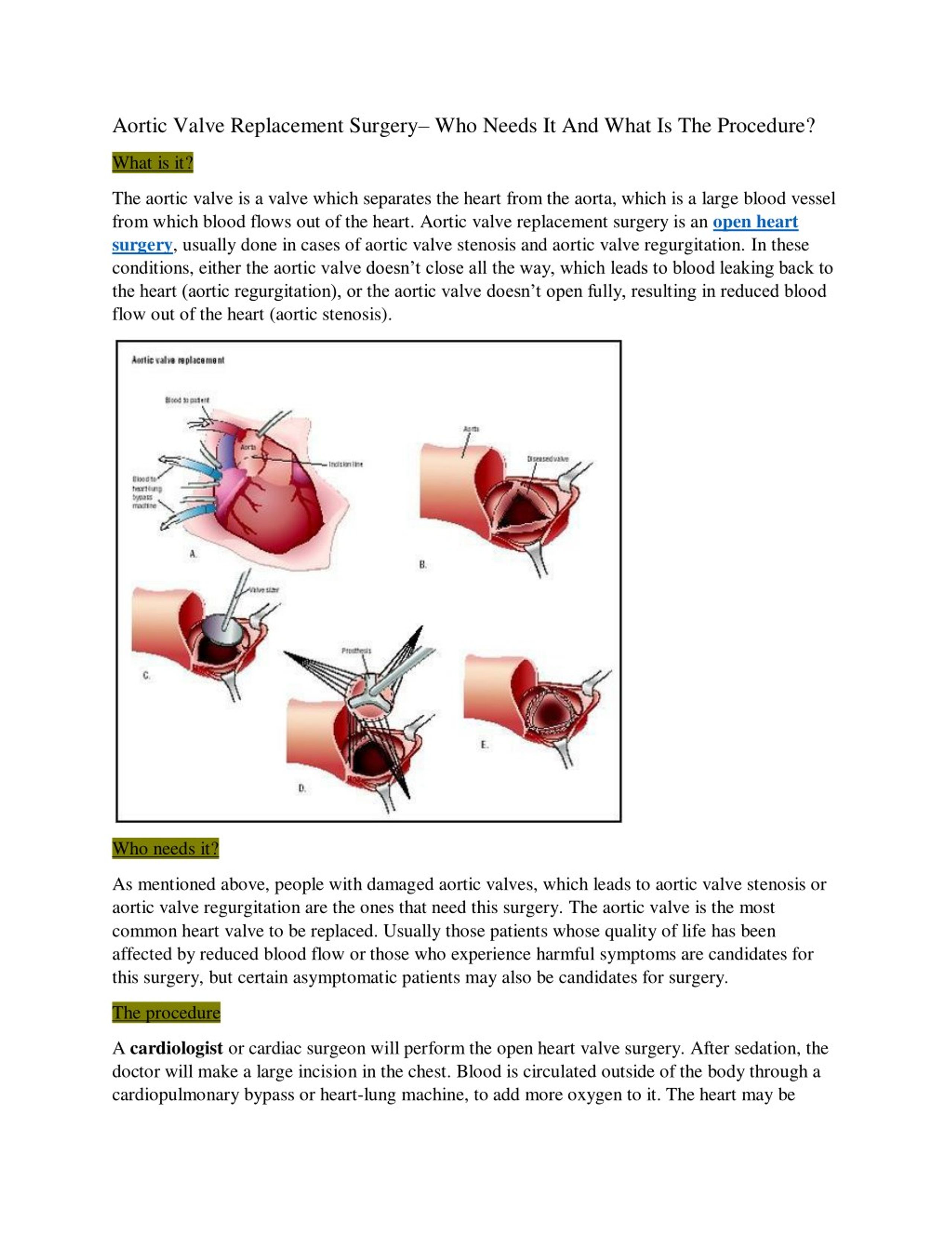 ppt-aortic-valve-replacement-surgery-who-needs-it-and-what-is-the