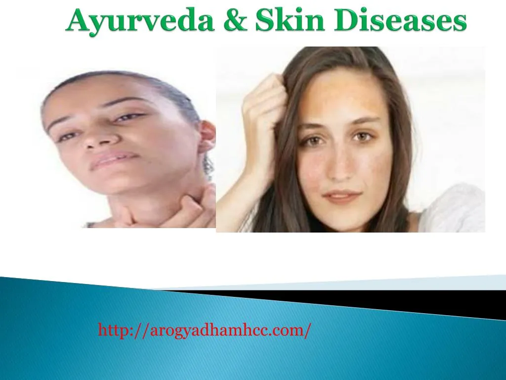 ayurveda skin diseases n.