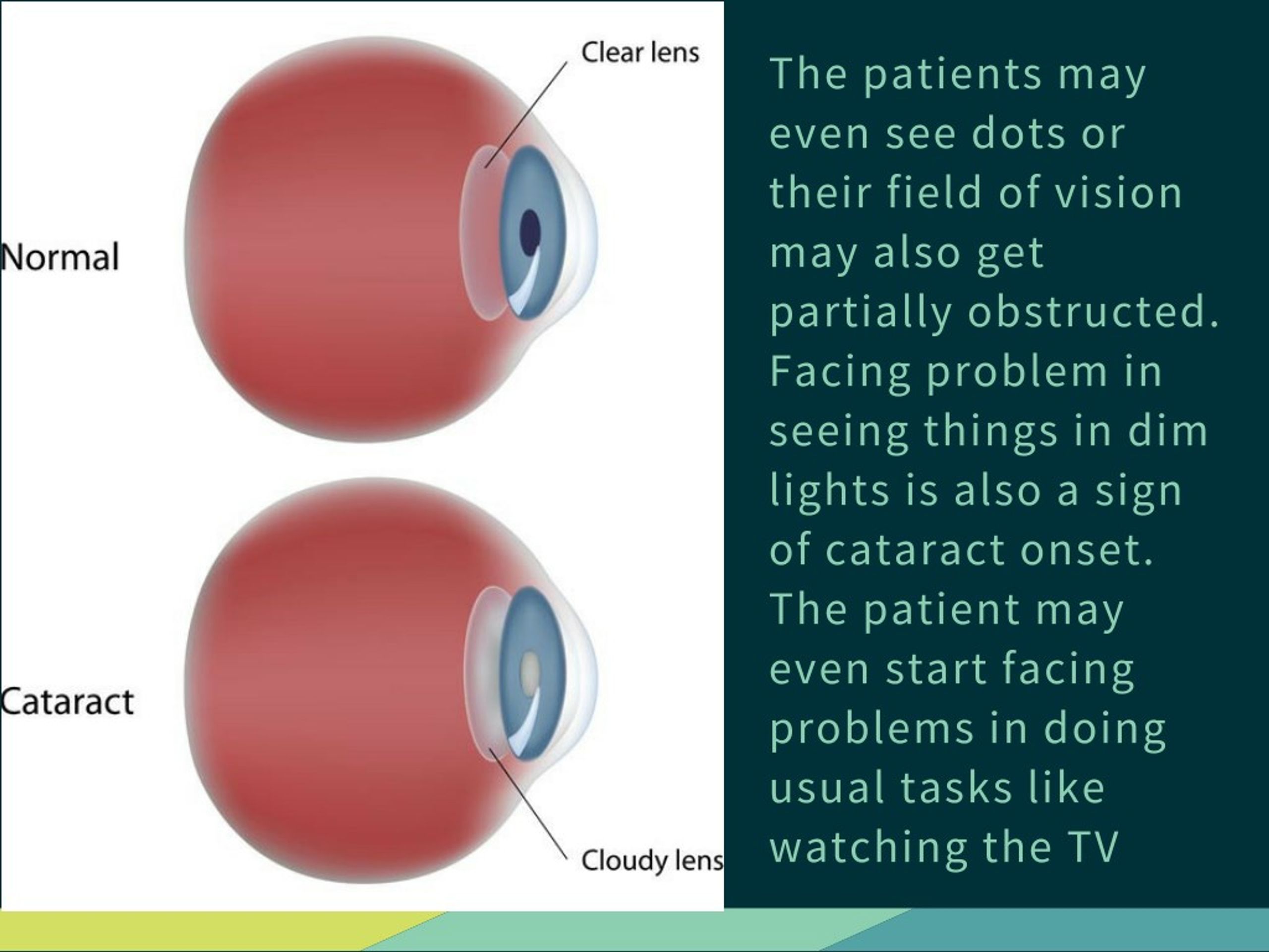 PPT - Cataract - The Blinding Menace PowerPoint Presentation, free ...