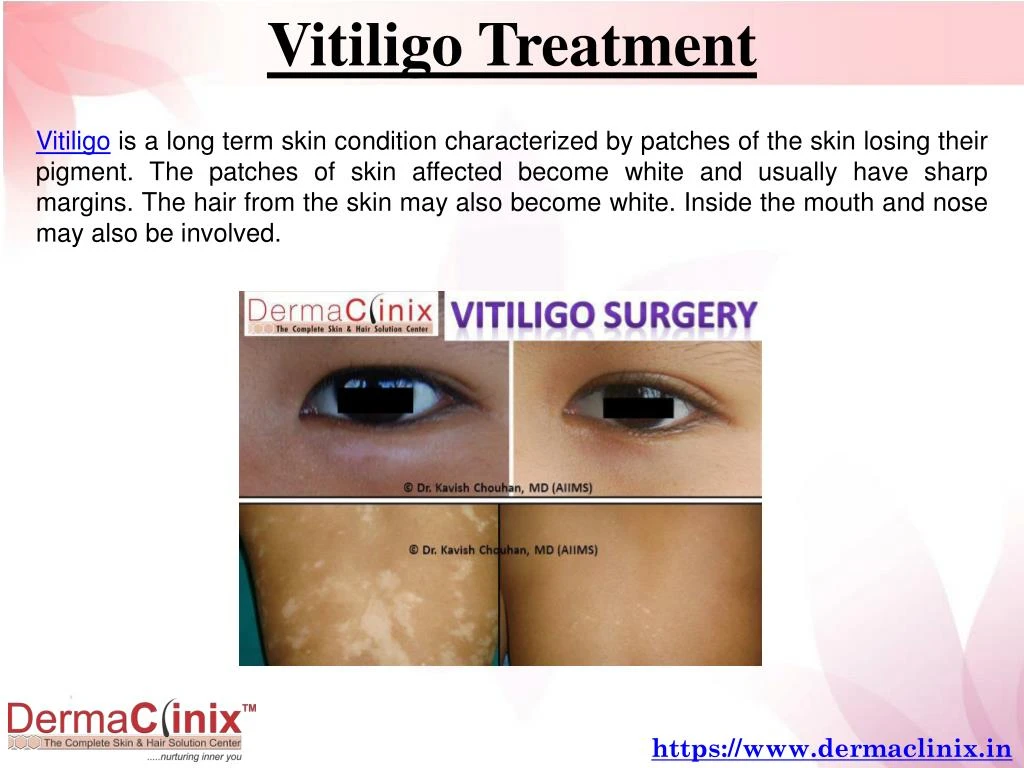 vitiligo case study ppt
