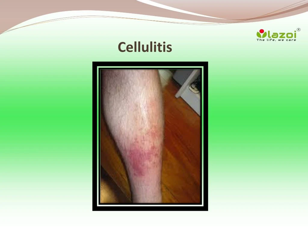 Cellulitis Causes And Symptoms Cellulitis Symptoms And Causes The