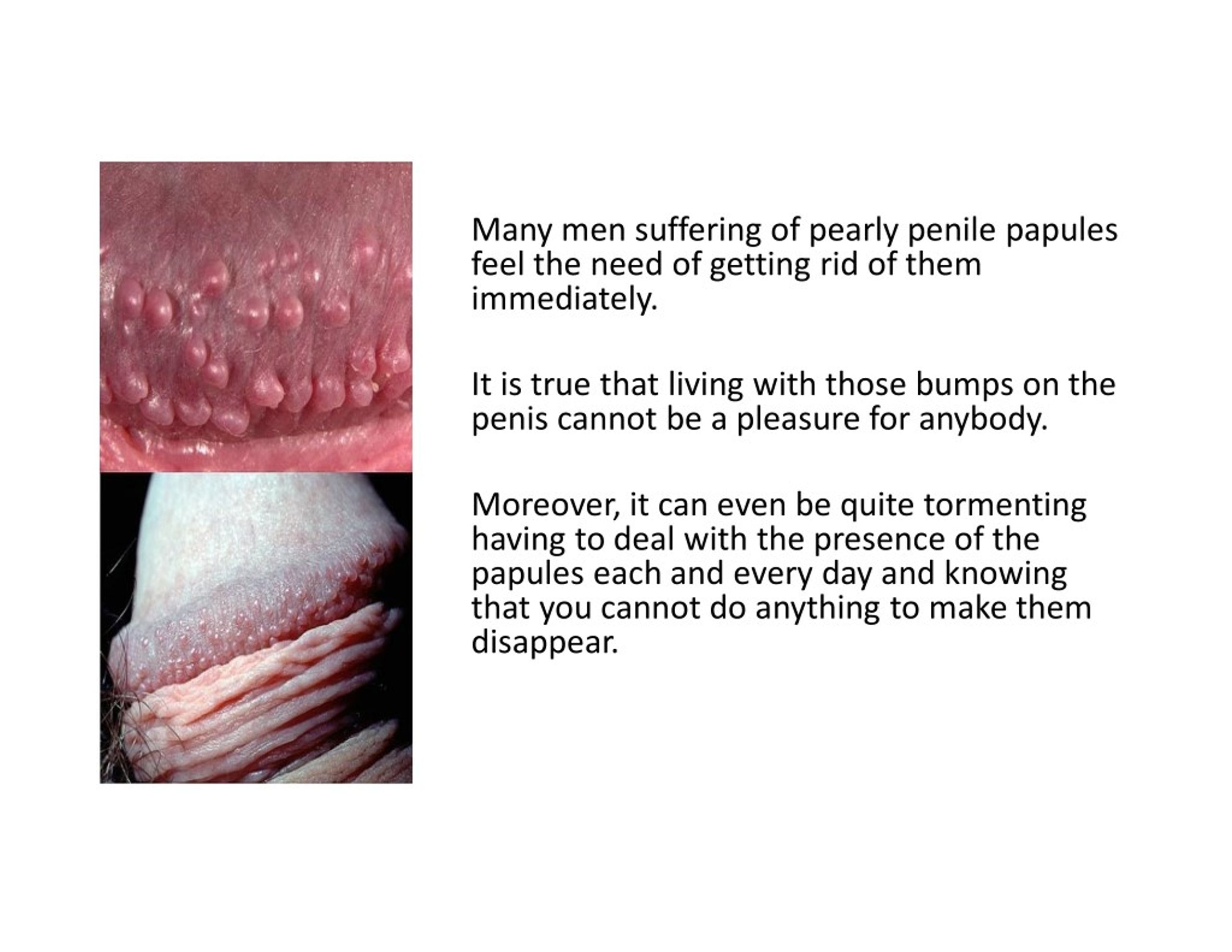 Away papules pearly penile go Pearly papules