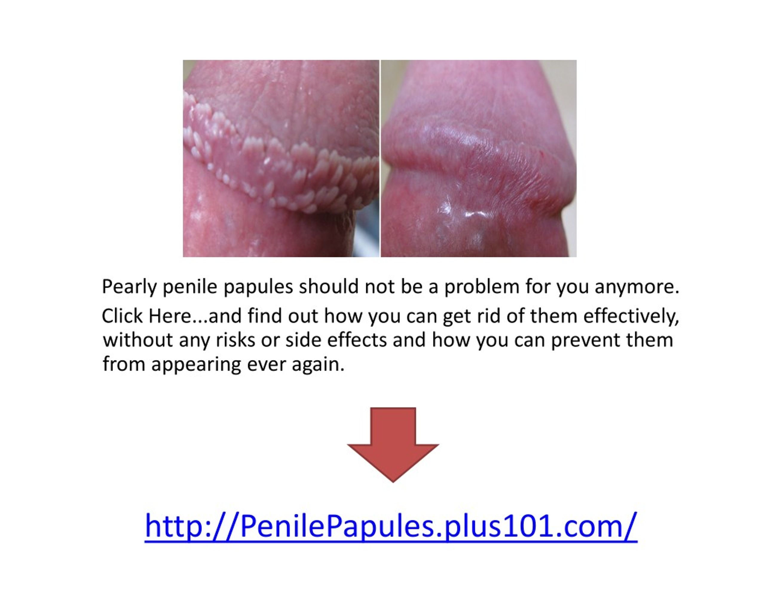 Go pearly away papules penile Penis Lump: