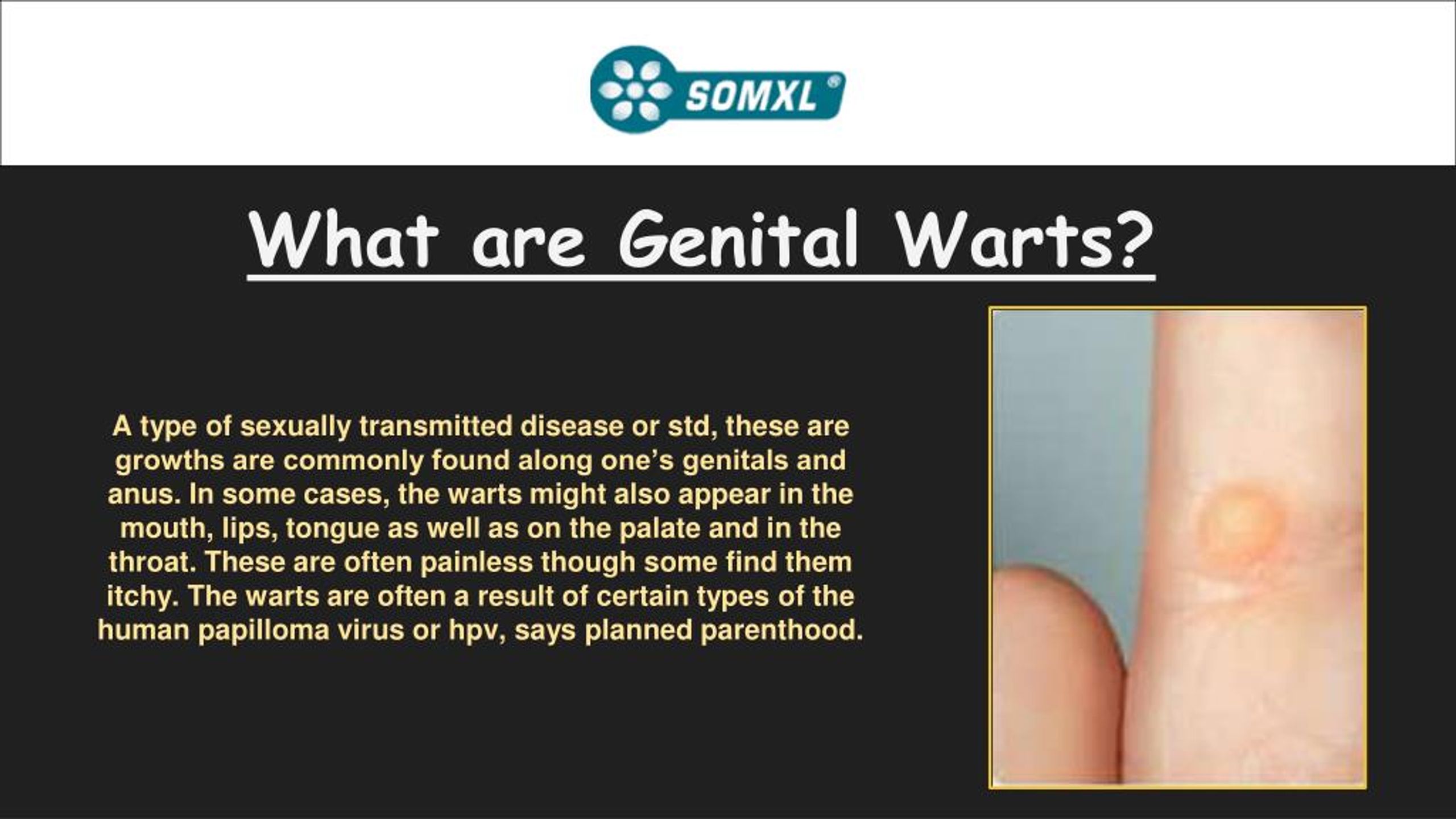 Ppt Get Rid Of Genital Wart By Somxl Wartcream Powerpoint Presentation Id 7806320