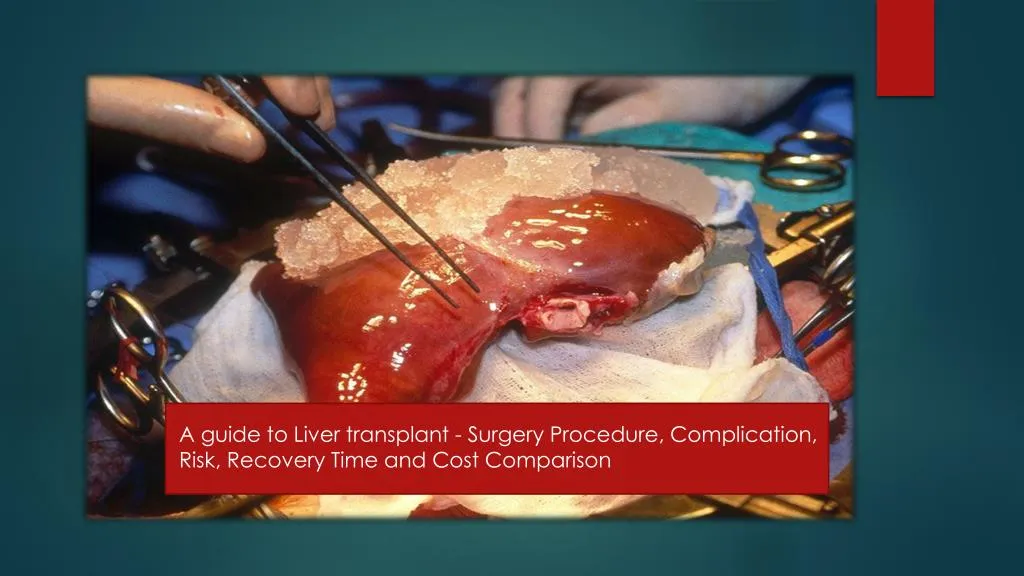 PPT A guide to Liver transplant Surgery Procedure