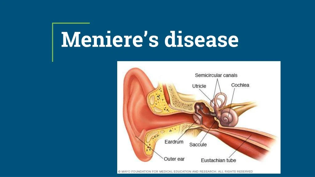 PPT Do You Know Meniereâ€™s disease PowerPoint Presentation, free