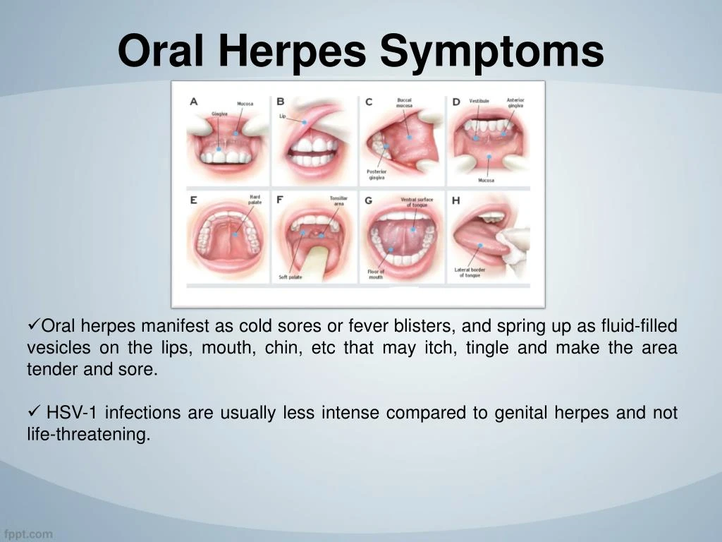 ppt-oral-herpes-symptoms-causes-how-to-get-rid-of-cold-sores