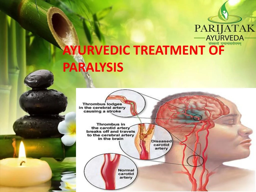 Ppt Best Ayurvedic Treatment Paralysis India Ayurveda For Paralysis Kerala Powerpoint