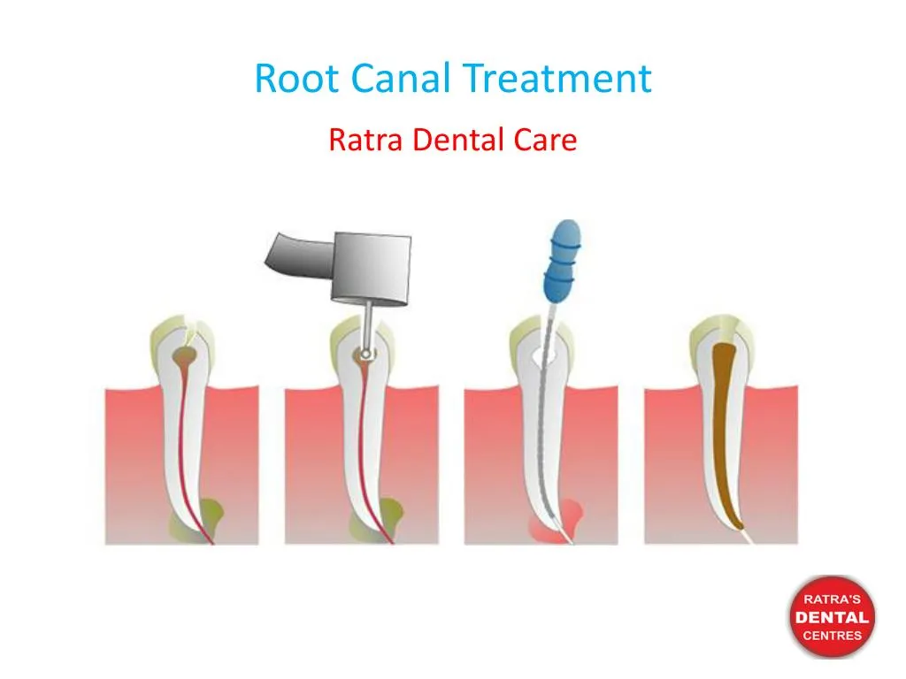 PPT Root Canal Treatment PowerPoint Presentation, free download ID