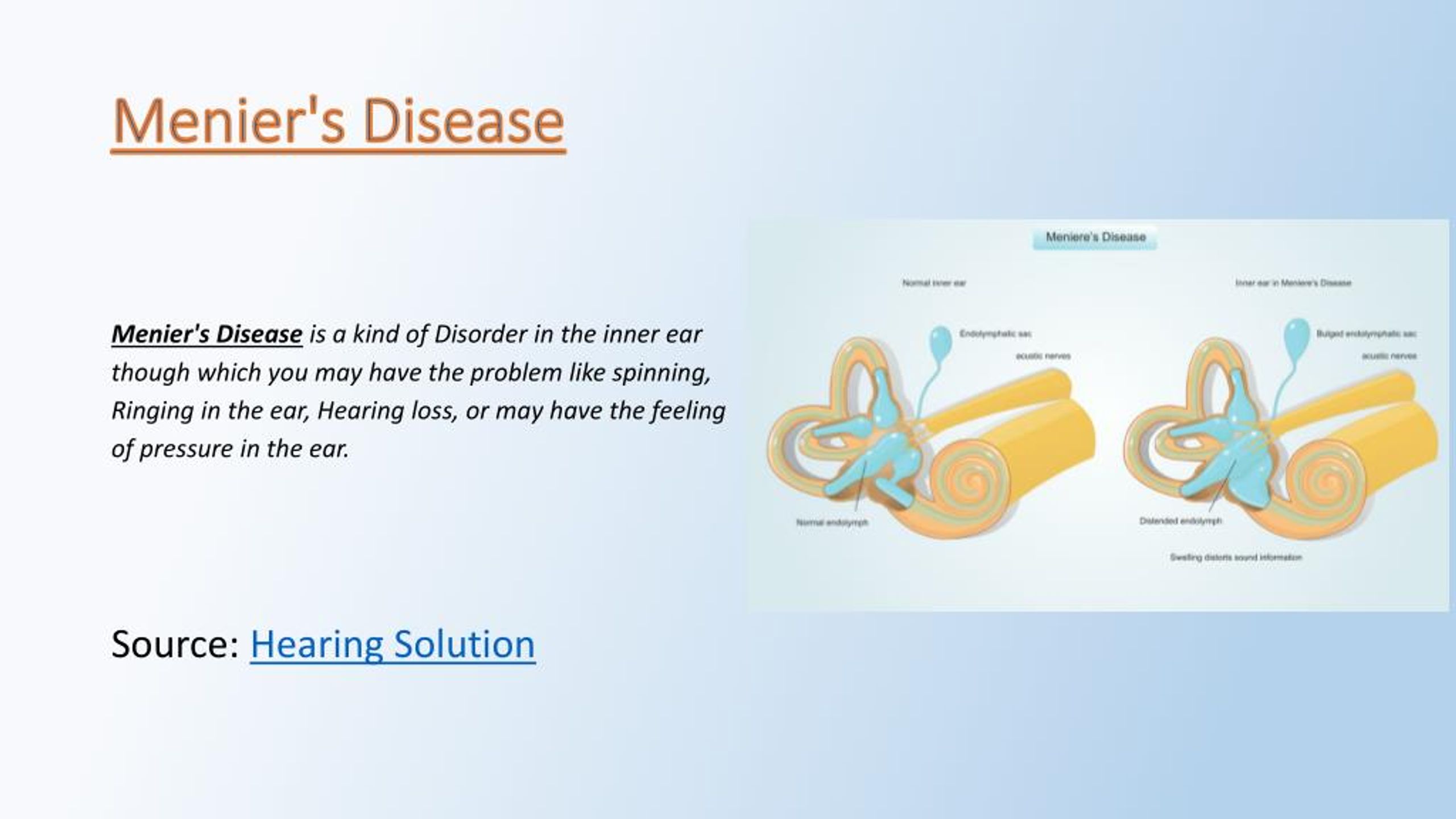 Ppt Menieres Disease Powerpoint Presentation Free Download Id7925726 5187