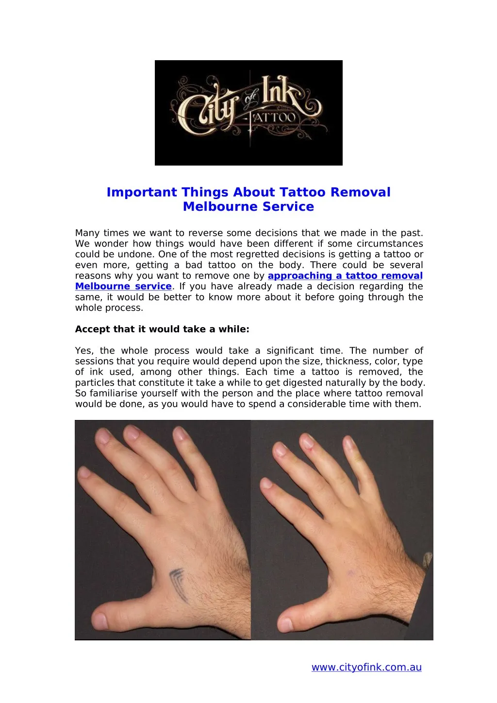 important things about tattoo removal melbourne n.