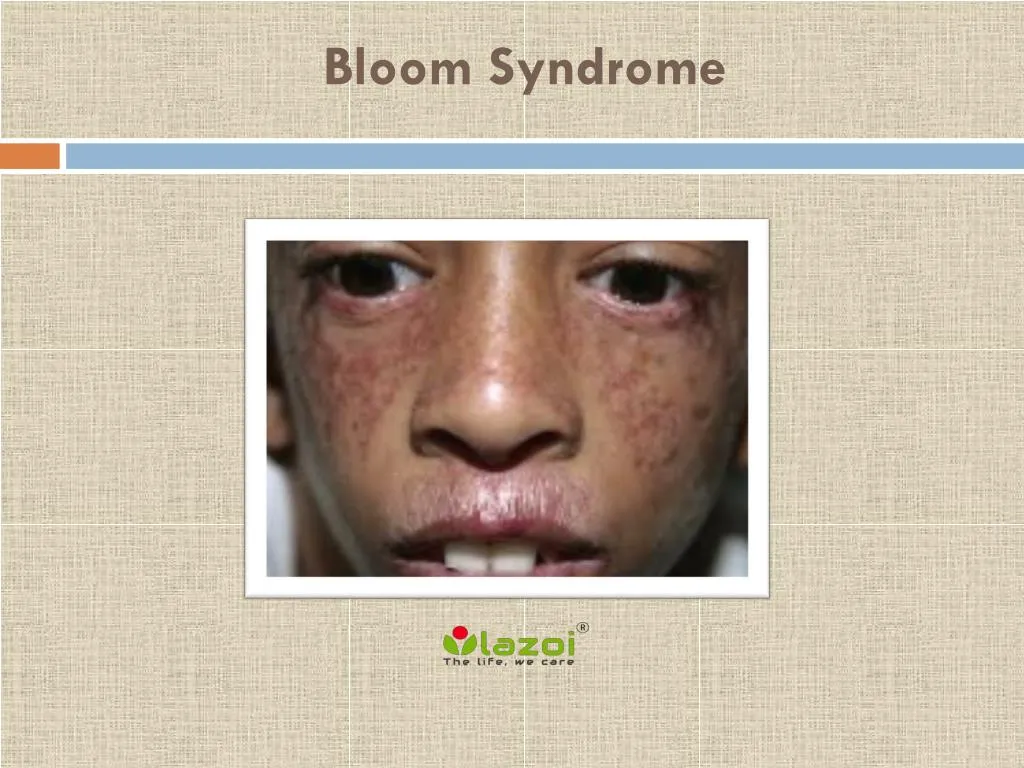 bloom syndrome bloom syndrome