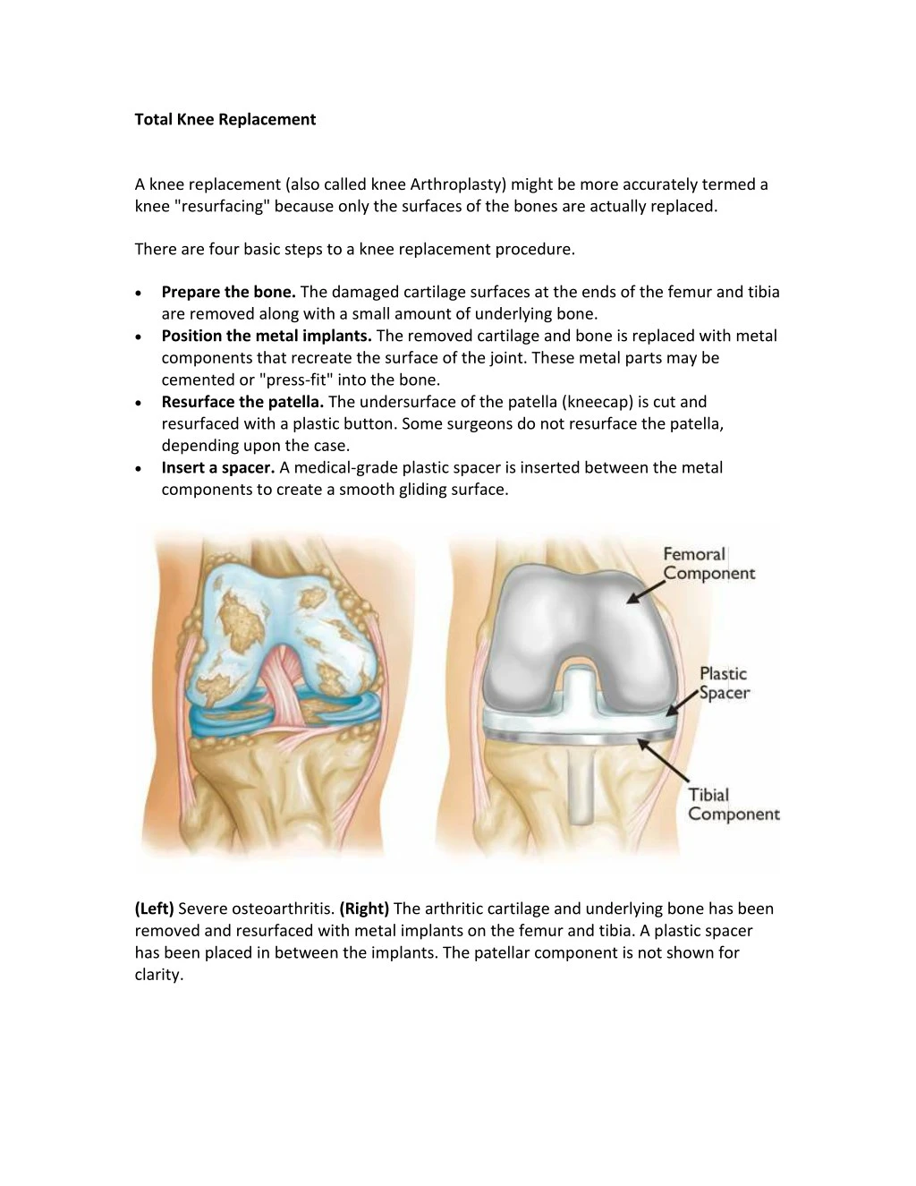 PPT - Total Knee Joint Replacement Surgery|Best Knee Surgeon|Orthopedic ...