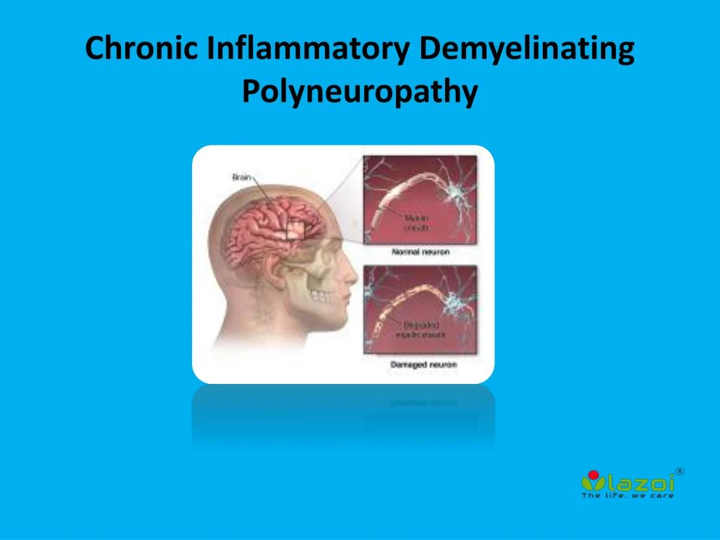 Ppt chronic inflammatory demyelinating polyneuropathy powerpoint