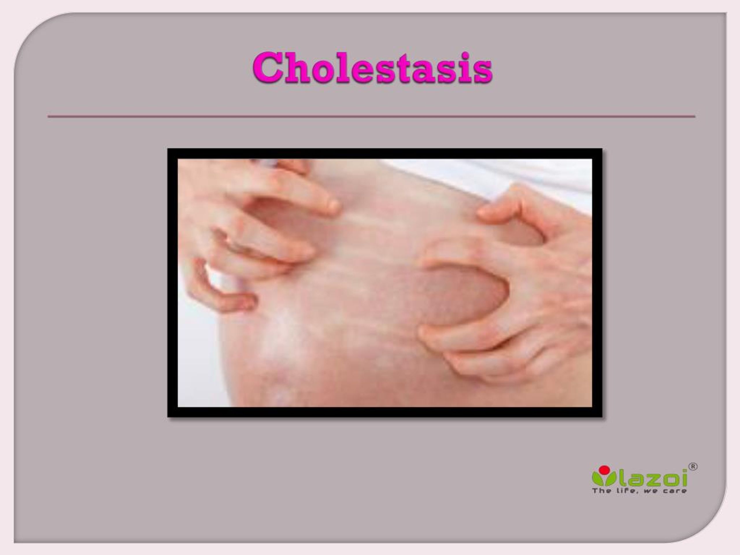 PPT Cholestasis PowerPoint Presentation, free download ID7940145