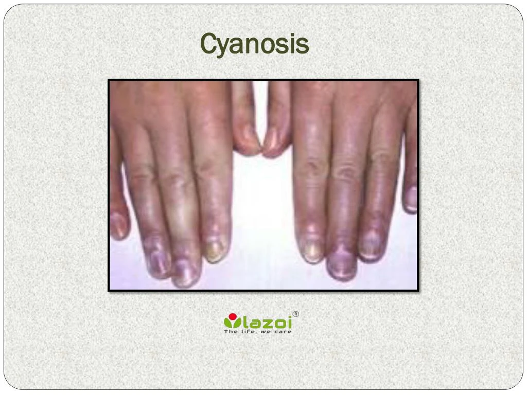 PPT - Cyanosis PowerPoint Presentation, free download - ID:7942880