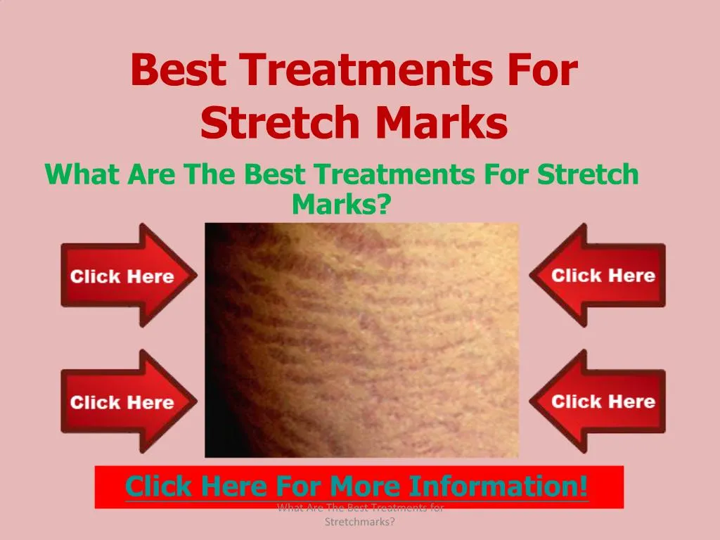 best treatment for new stretch marks