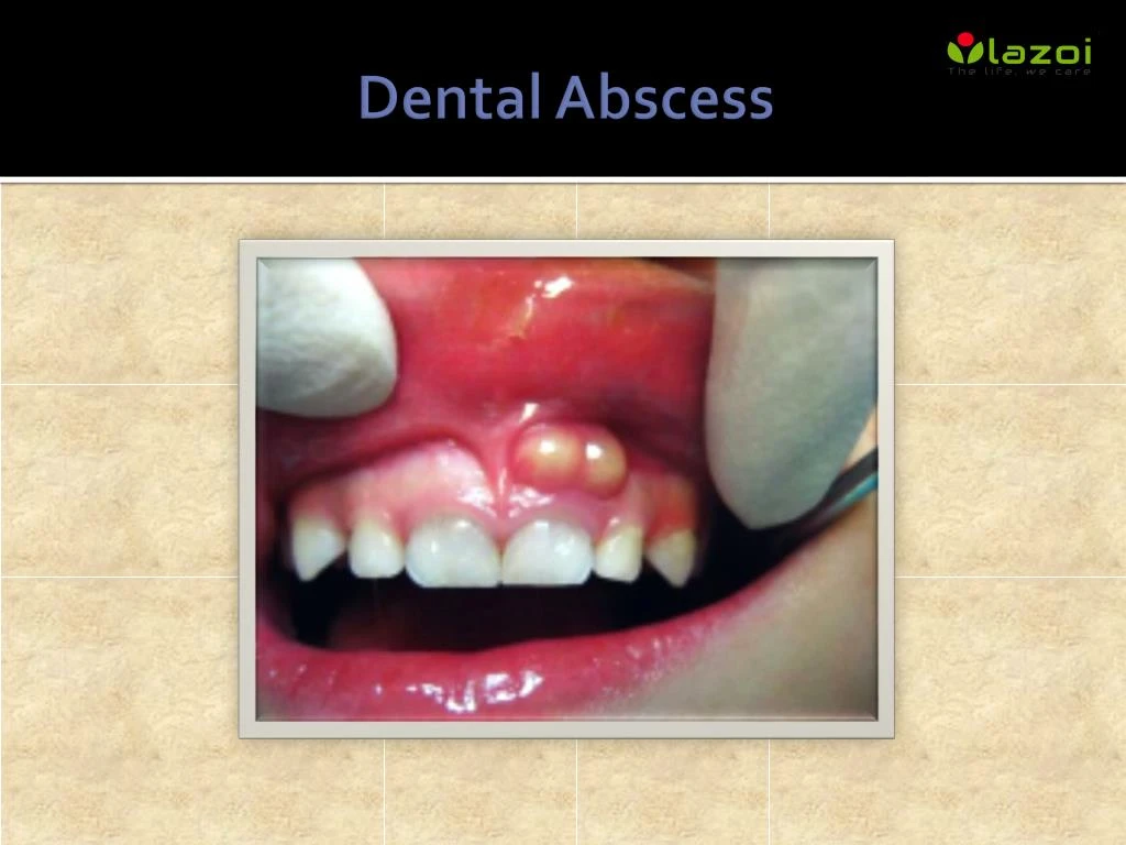 PPT - Dental Abscess PowerPoint Presentation, free download - ID:7945735