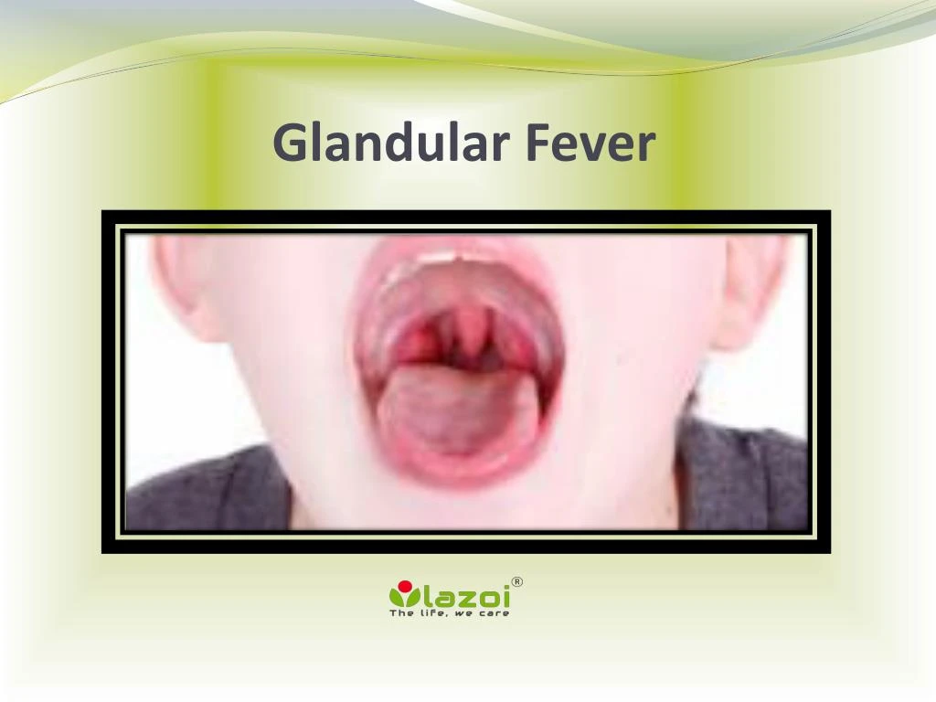 ppt-glandular-fever-powerpoint-presentation-free-download-id-7953698