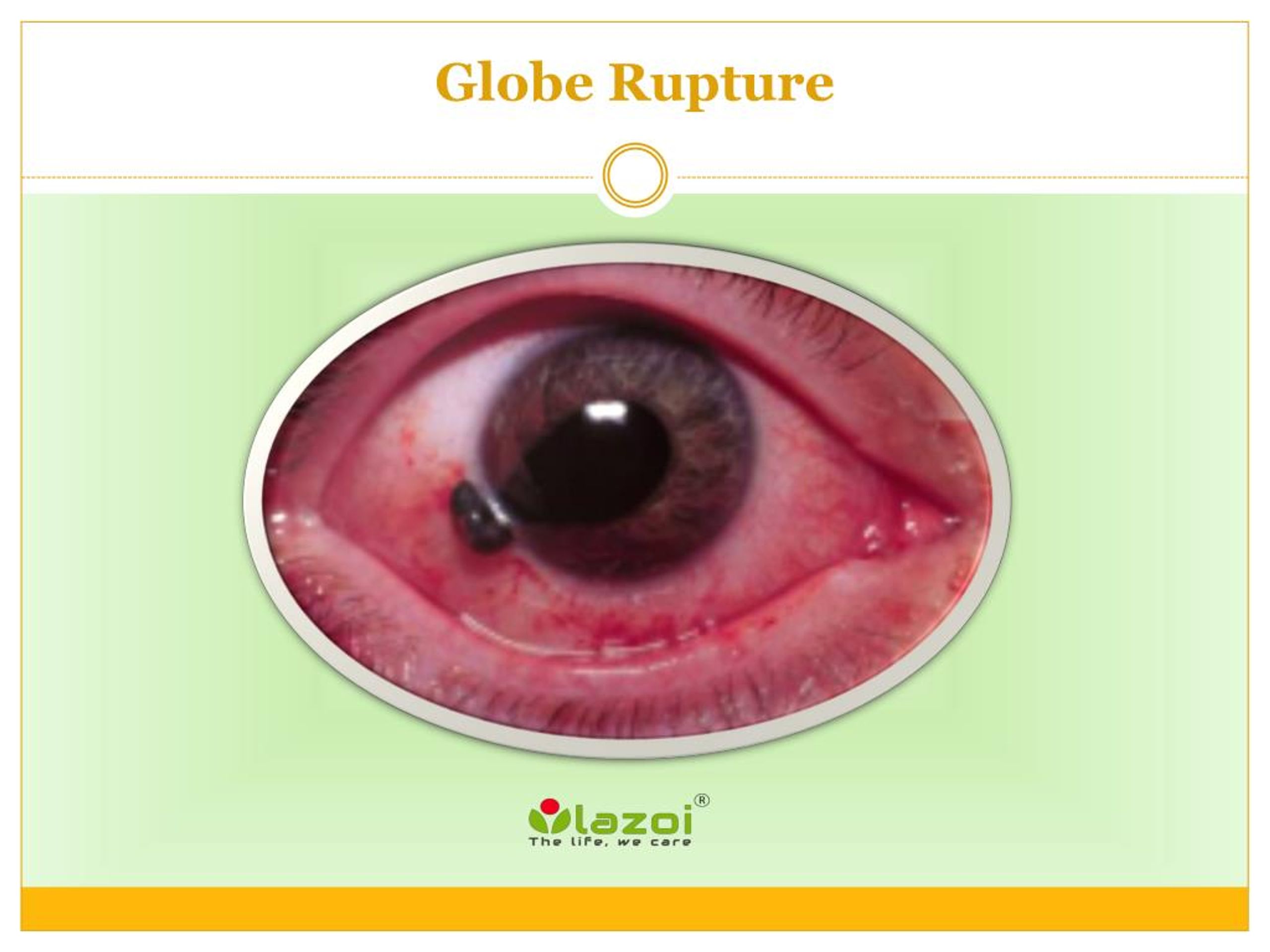 PPT Globe Rupture PowerPoint Presentation Free Download ID 7955512 PPT Globe Rupture PowerPoint Presentation Free Download ID 7955512